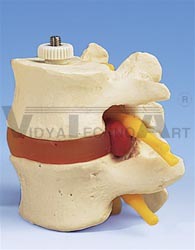 2 Lumbar Vertebrae with prolapsed disc, flexibly mounted